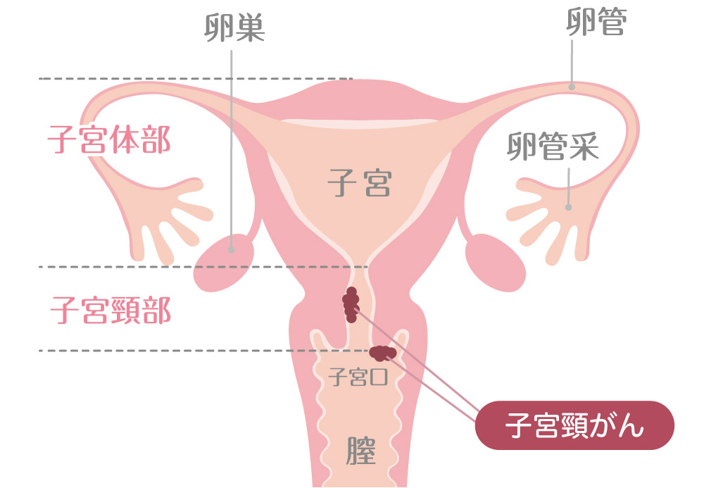 子宮頸がん