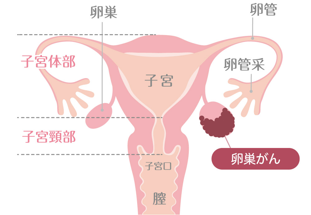 卵巣がん