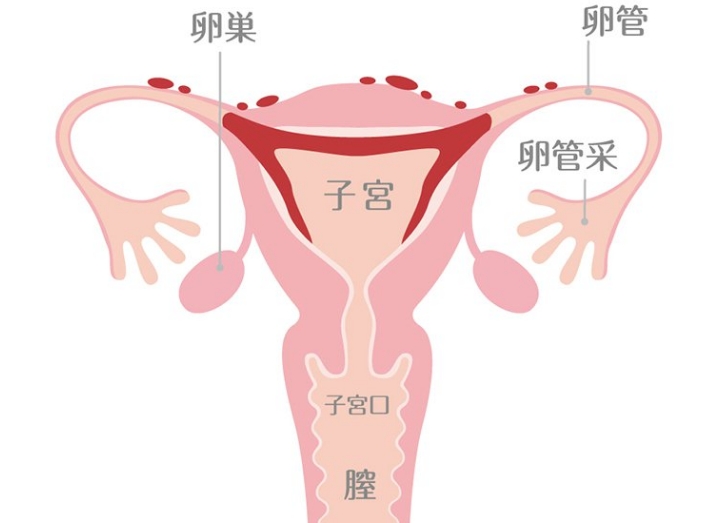 子宮内膜症とは