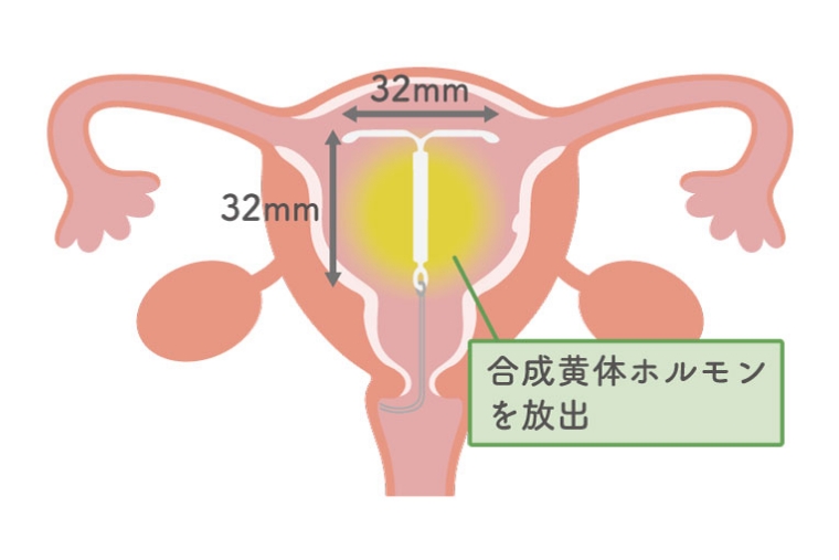 ミレーナとは