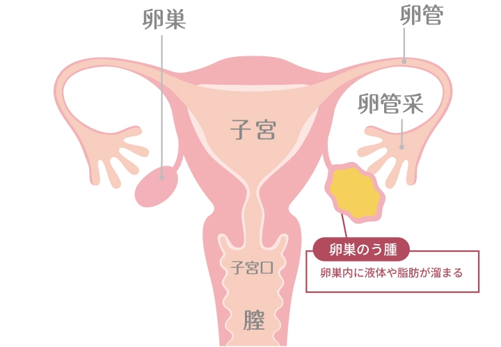 卵巣のう腫の種類