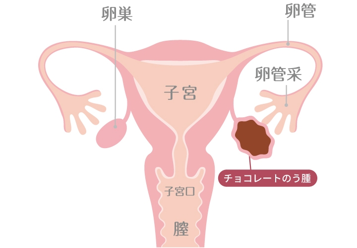 内膜症性のう胞（チョコレートのう腫）