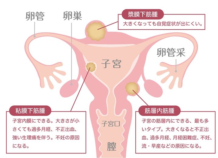 子宮筋腫とは