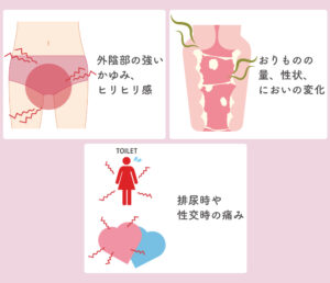 腟カンジダの症状。外陰部のかゆみ、ヒリヒリ感。おりものの量、性状、においの変化。排尿時や性交時の痛み。