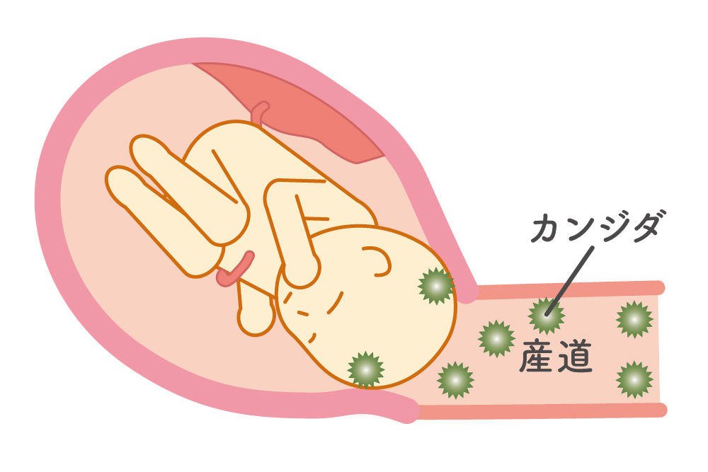 分娩の際、赤ちゃんが産道を通る時にカンジダに感染
産道感染