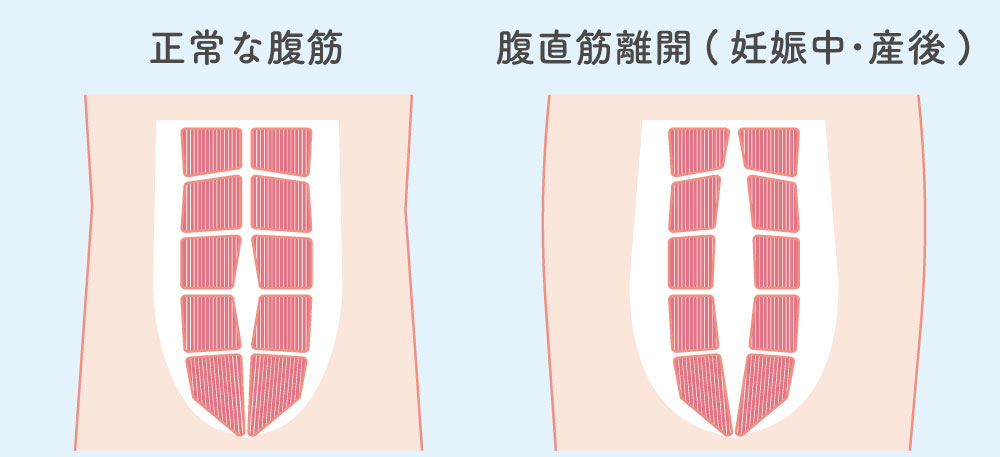 正常な腹筋と腹直筋離開