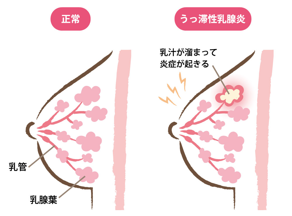 うっ滞性乳腺炎