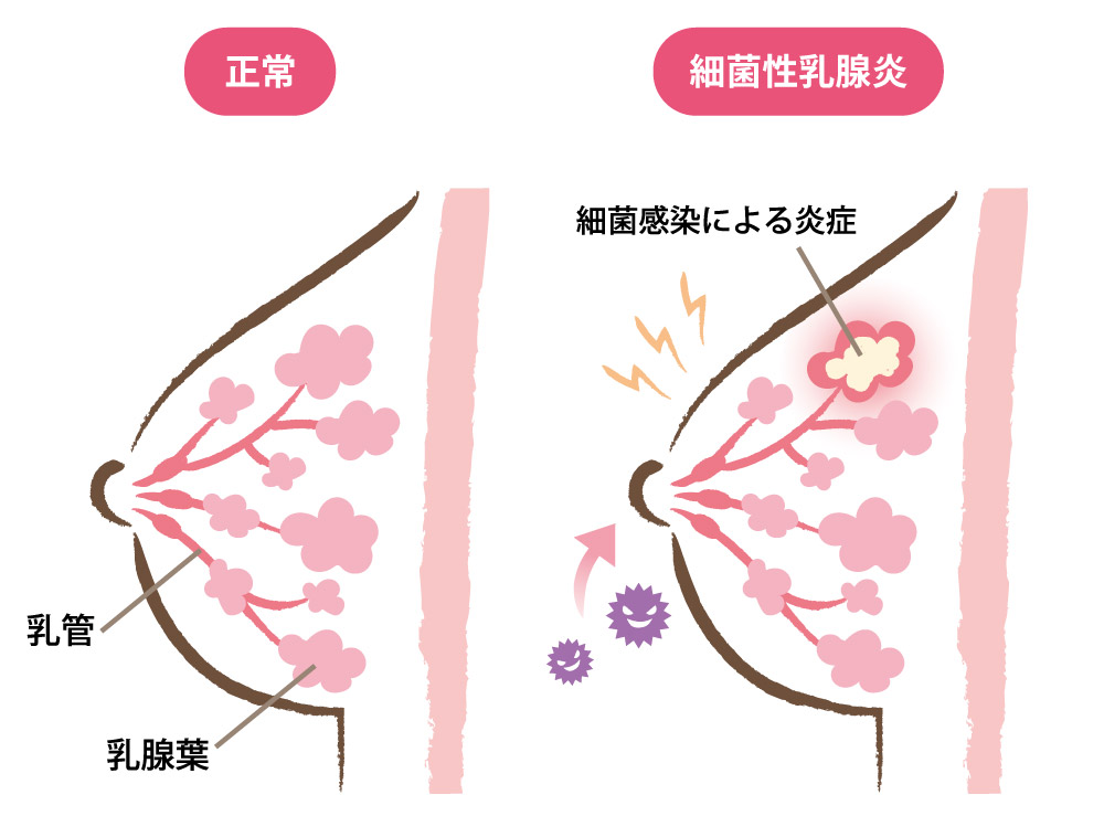 細菌性乳腺炎